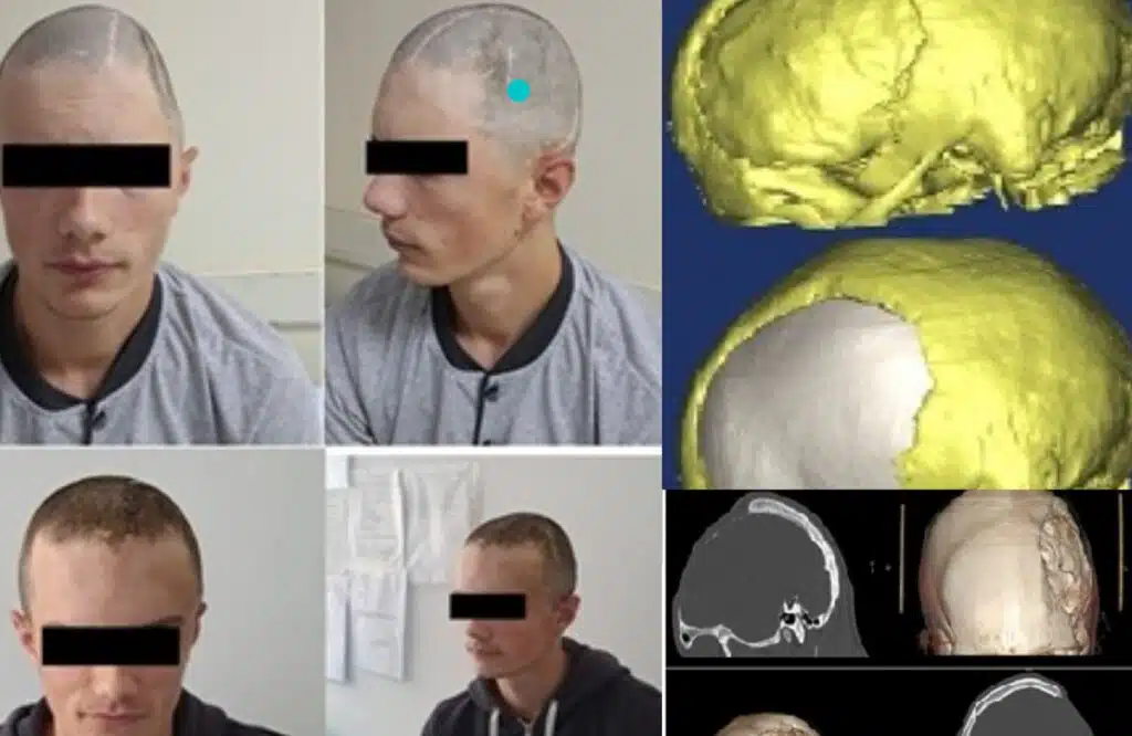 Uspjeh zeničkih ljekara: Obavljena još jedna kompleksna 3D rekonstrukcija lobanje