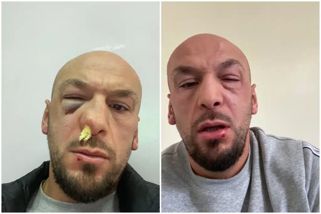 Iron Puki napadnut u Sarajevu: “Adnan Redžović me napao u Općini Centar”