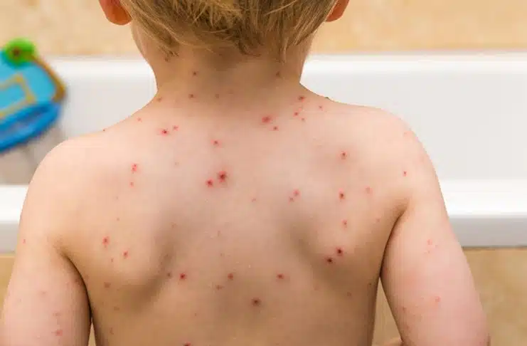 Proglašena epidemija morbila u Tuzlanskom kantonu