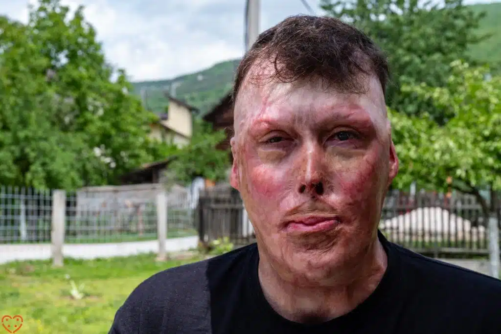 Udruženje Pomozi.ba pokrenulo apel za liječenje Aldina koji je 2016. godine živ spaljen