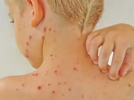 Ministarstvo zdravstva Kantona Sarajevo upozorilo na epidemiju morbila: “Nedovoljan broj vakcinisane djece glavni uzrok širenja bolesti”