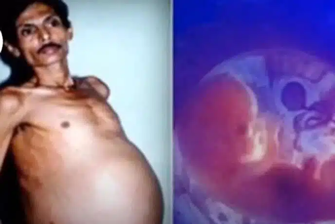 GODINAMA MU JE RASTAO STOMAK, A LJEKARI SU U NJEGOVOM TIJELU NAŠLI FETUS Više od 30 godina živio je sa tim u stomaku, a onda je otkriven fenomen